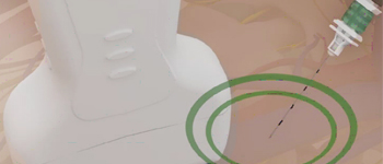 needle-guidance-technology